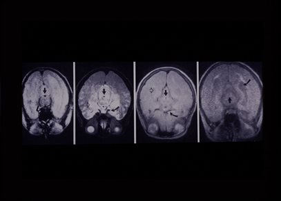 Four black and white MRI images of horizontal cross-sections through a human brain.  This image is from the papers of Brian Worthington, held by Manuscripts and Special Collections.  Document reference PBW/12/8/10.