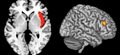 Schizophrenia symptoms linked to faulty 'switch' in brain
