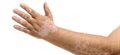Clinical trial to test two treatments for vitiligo sufferers