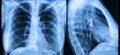Top research priorities for cystic fibrosis treatments revealed