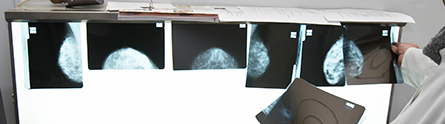 breast-cancerpr