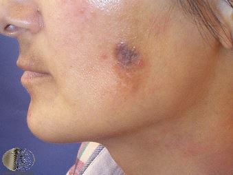 Dermoscopy of Tinea Manuum. - Abstract - Europe PMC