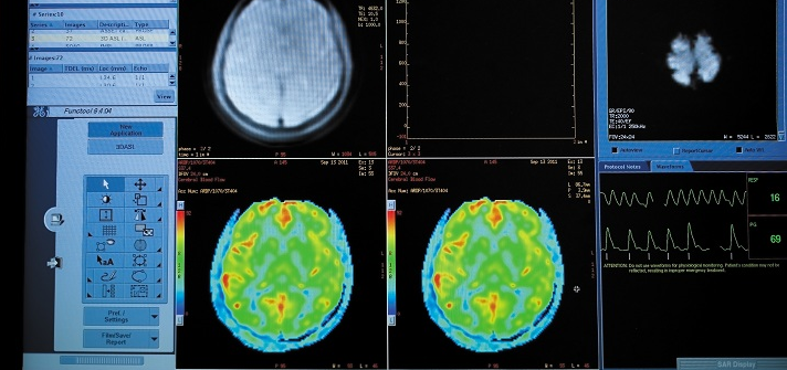 MRI scan displayed on screen