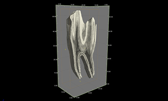 A 3D computer rendering showing the centre section of a tooth