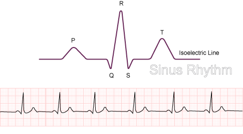 Diagram normal sinus rhythm