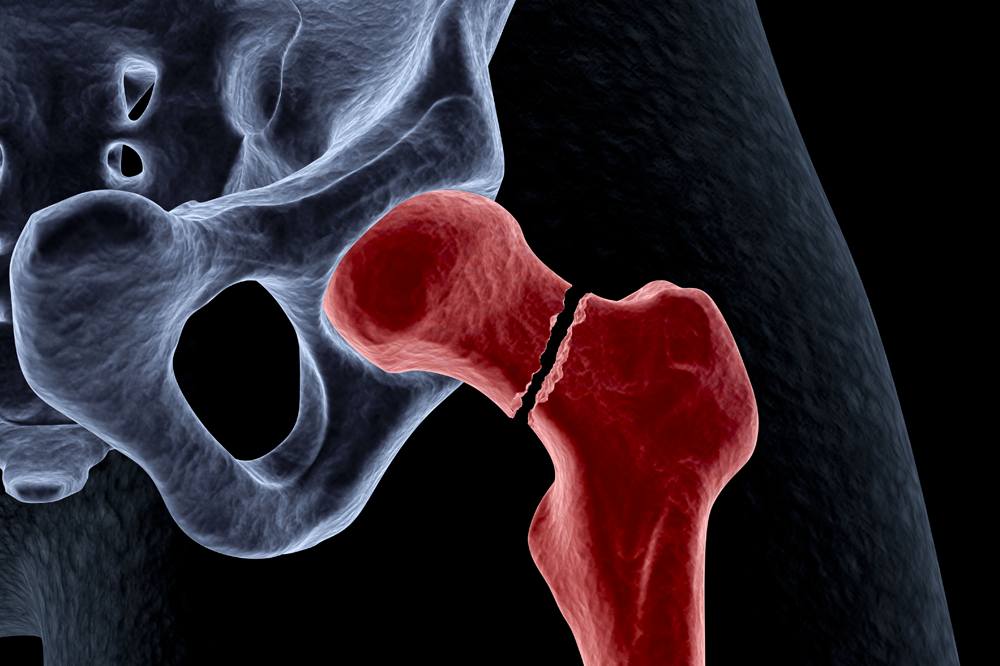Digital medical illustration depicting a hip fracture often seen in cases of osteoporosis; intracapsular (femoral neck) fracture: a fracture of the neck of the femur.